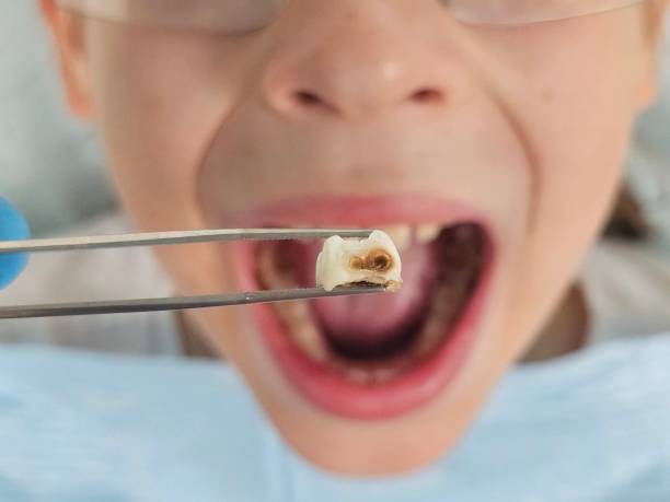 Best Emergency Wisdom Teeth Removal in Princevle, IL