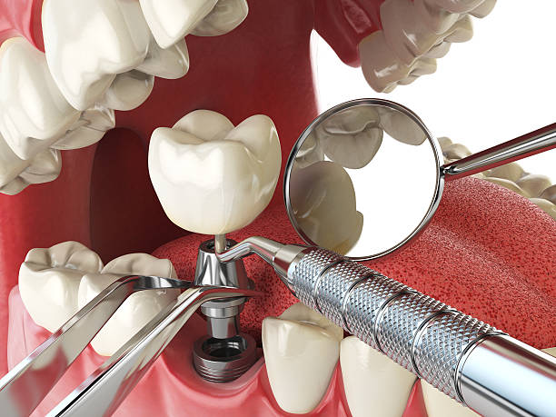 Best Emergency Treatment for Toothache in Princevle, IL